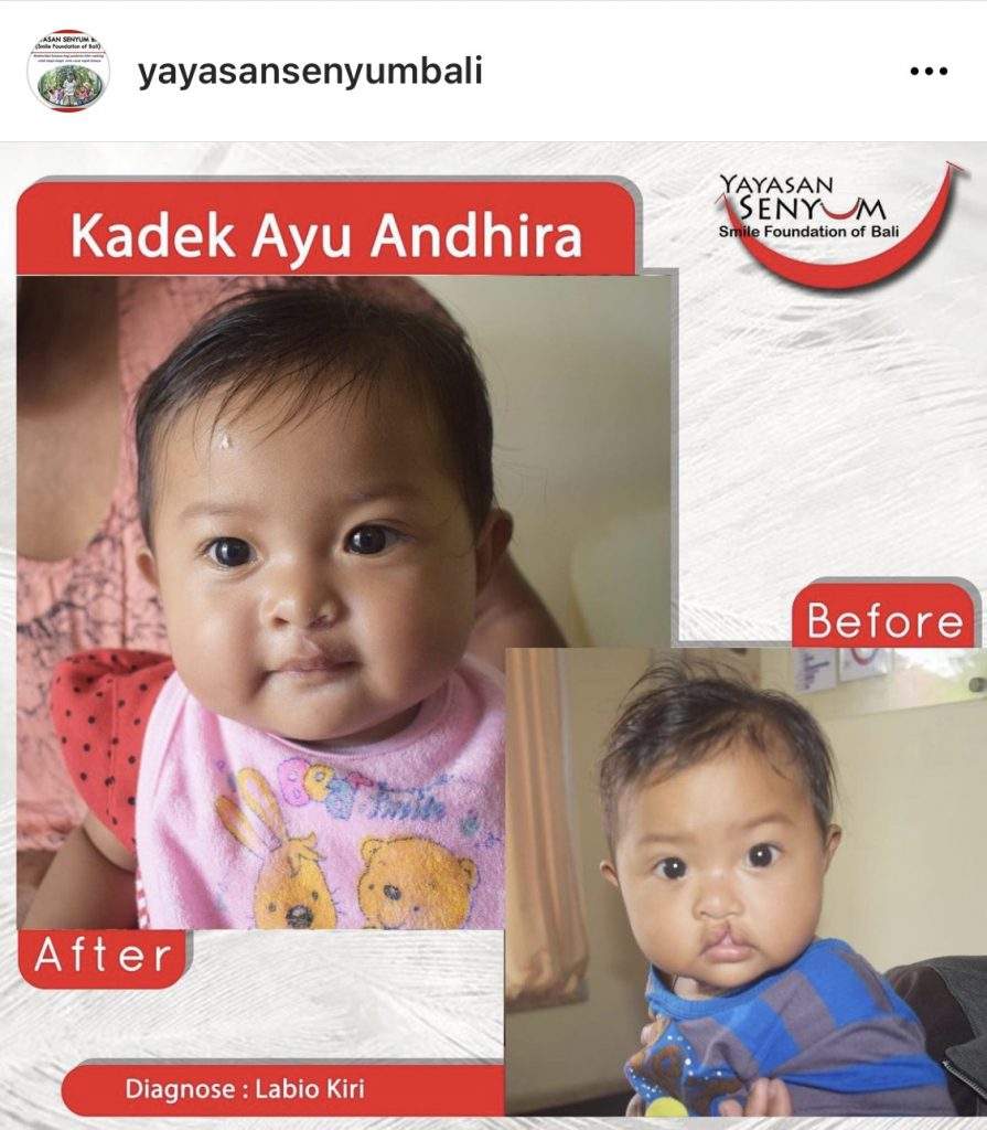 outreach at yayasan senyum bali